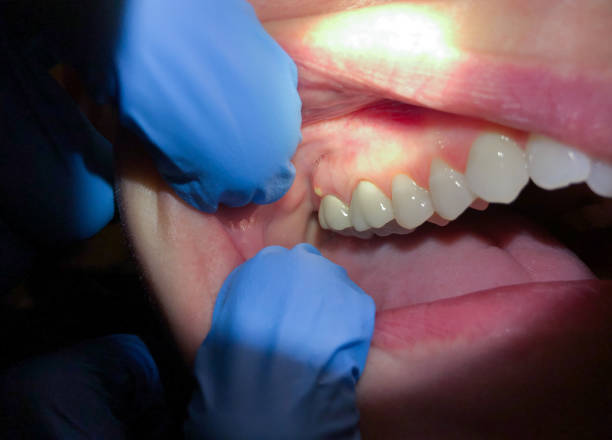 Best Emergency Gum Treatment in Carbondale, IL